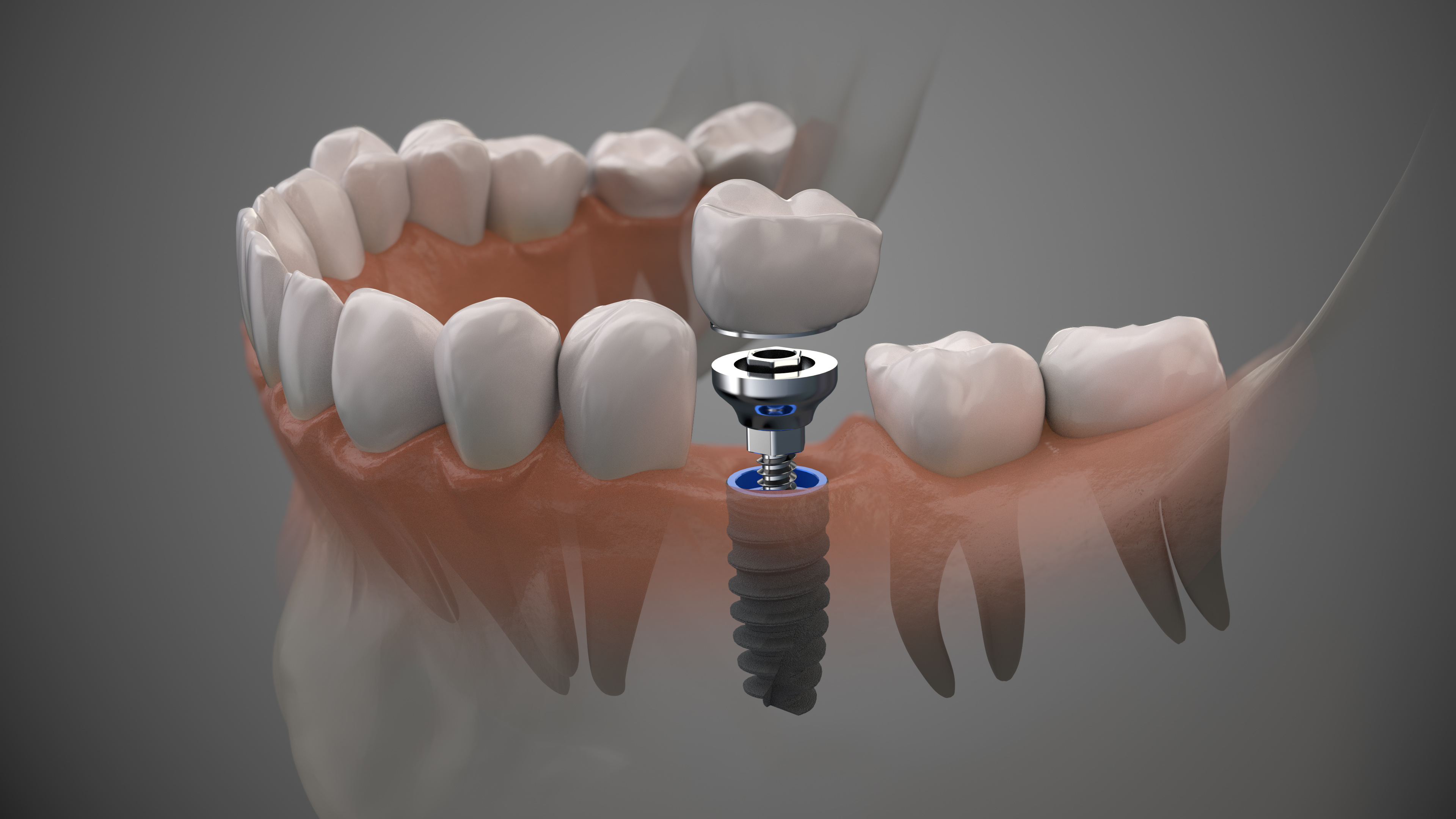 Dental Implants in Dallas