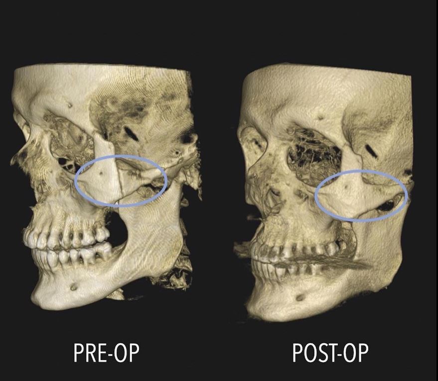 Before and after surgery picture